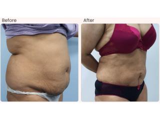 Liposuction Surgery in Delhi - Dr Rajat Gupta