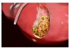 Expert Gallbladder Stone Surgery Doctor in Kolkata