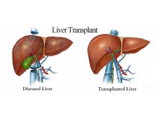 Liver Transplant in India | Expert Care with MyCure Pathway