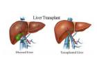 Liver Transplant in India | Expert Care with MyCure Pathway