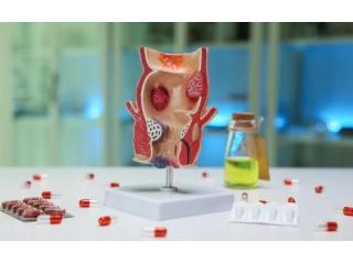 Dr. Kyriakos Neofytou: Hemorrhoids Treatment for Effective Relief and Better Comfort