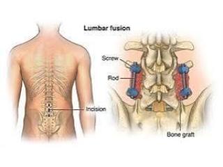 Lumbar Spinal Stenosis Treatment in Gurgaon : Effective Treatment for Professional Physiotherapists
