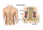 Lumbar Spinal Stenosis Treatment in Gurgaon : Effective Treatment for Professional Physiotherapists
