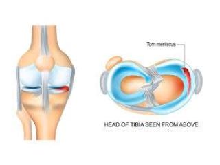 Meniscus Injury in Gurgaon : Repairing Mobility using the highest level of precision