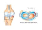 Meniscus Injury in Gurgaon : Repairing Mobility using the highest level of precision 