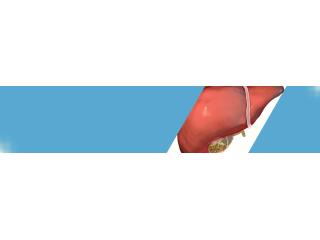 Gallbladder Stone Treatment in Ahmedabad - Dr. Nirav Vakani