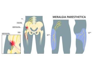 Meralgia Paresthetica Treatment in Gurgaon : Expert Physiotherapists in Gurgaon
