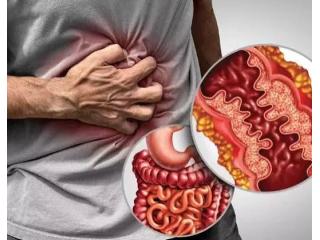 Dr. Jigar Patel for Advanced IBD Treatment in Ahmedabad