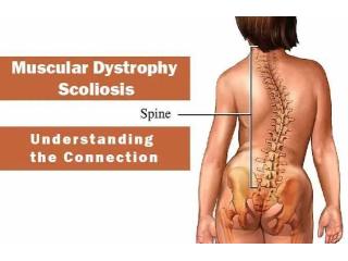 Muscular Dystrophy Treatment in Gurgaon : effective physiotherapy treatment to patients