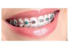 Braces in Oxnard CA – Affordable Orthodontic Treatment for a Straighter Smile