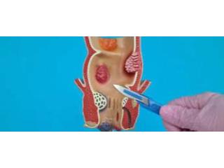 Expert Care with the Best Fistula Surgeon in Kolkata