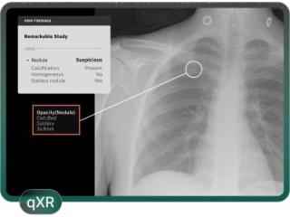 IPN Program for Earlier Lung Nodule Detection