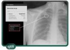 IPN Program for Earlier Lung Nodule Detection