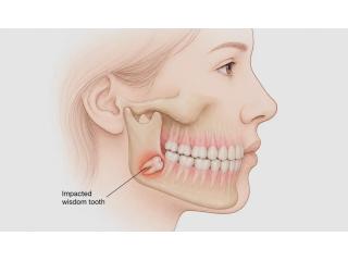 Wisdom Tooth Removal Near Me for Expert Dental Care