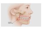 Wisdom Tooth Removal Near Me for Expert Dental Care
