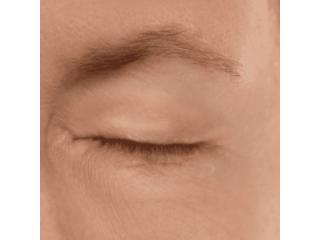 Blepharoplasty Surgery Surrey