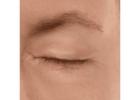 Blepharoplasty Surgery Surrey
