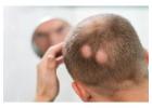 Alopecia Specialist Georgia | Hair Clinique Restoration Center 
