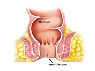 Expert Fissure Surgeon in Kolkata for Advanced Treatment