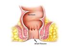 Expert Fissure Surgeon in Kolkata for Advanced Treatment