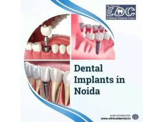 Single Tooth Implant in Noida | Ethical Dental Care