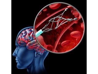 Stenting Operation for Improved Blood Flow Through Narrowed Arteries