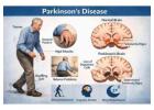 Comprehensive Parkinson's Care in Vasai | Sunshine Wellness Centre