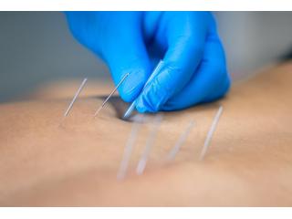 Acupuncture in Singapore for Pain and Stress Relief