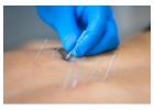 Acupuncture in Singapore for Pain and Stress Relief 