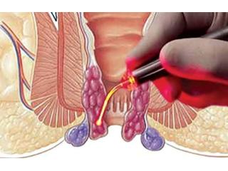 Expert Piles Surgeon in Kolkata – Dr. Purnendu Roy