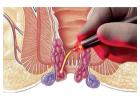 Expert Piles Surgeon in Kolkata – Dr. Purnendu Roy  