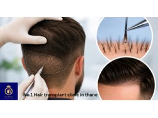 Advanced No.1 Hair Transplant Clinic in Thane – DNA Royal.