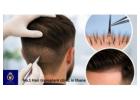 Advanced No.1 Hair Transplant Clinic in Thane – DNA Royal.
