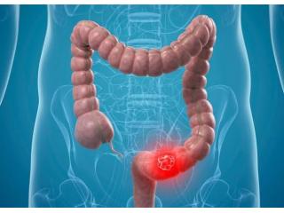 Managing Intestinal Malignancies with Dr. Jigar Patel