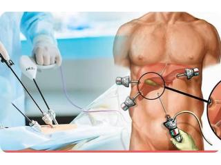 Dr. Purnendu Roy for Laparoscopic Gallbladder Surgery Kolkata