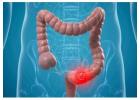 Managing Intestinal Malignancies with Dr. Jigar Patel