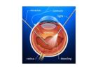 Is Retina Operation Risky? Risks & Recovery Explained
