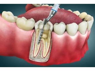 Root Canal Treatment Guide in Abbotsford | What You Need to Know