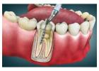 Root Canal Treatment Guide in Abbotsford | What You Need to Know