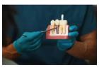 Trusted Professional Teeth Whitening at Rosedale Smiles