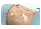 Best Hernia Surgeon in Dum Dum Park for Expert Treatment  