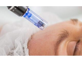 Professional Microneedling in Reading | Ankita B Dhingra