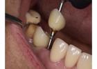 Get that Ideal Smile Makeover from the Best Tijuana Dentist