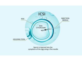 ICSI Treatment in Delhi - Dr Rhythm Gupta