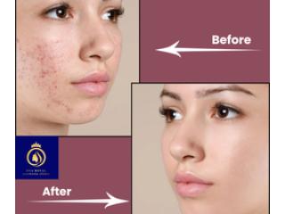 Professional Laser Resurfacing Treatment in Thane – DNA Royal Experts.