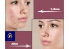 Professional Laser Resurfacing Treatment in Thane – DNA Royal Experts.