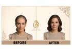 Hair Regrowth Treatment for Women in Thane | DNA Royal.