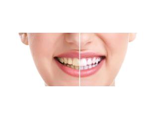 Why Are My Teeth Yellow? Causes & How to Whiten Them Safely