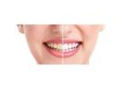 Why Are My Teeth Yellow? Causes & How to Whiten Them Safely