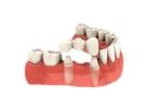 Pròtesi Dental Gines | Clinicadentalcristinamora.com